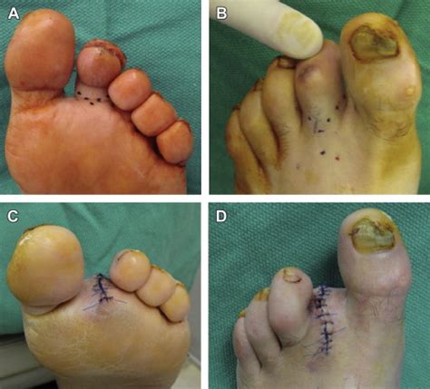 Partial Foot Amputations For Salvage Of The Diabetic Lower Extremity