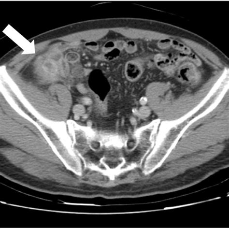 Axial View Of Abdominal And Pelvic Ct Scan With Contrast Shows Enlarged