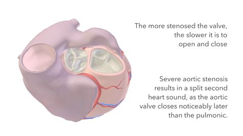 Aortic Stenosis Murmur Sound And Animation Youtube