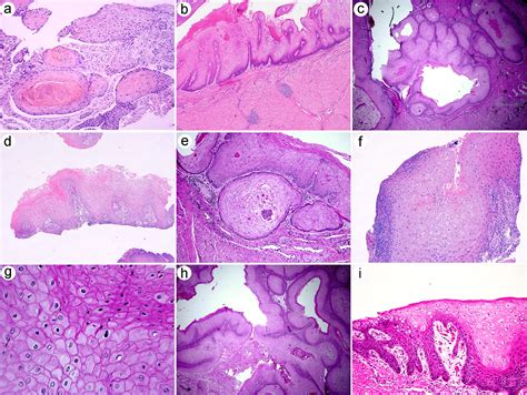 Squamous Cell Carcinoma Histology