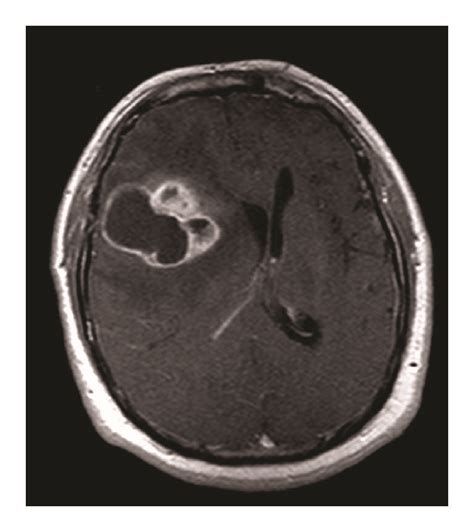 A And B Pre And Postcontrast Mri Demonstrating Large Right