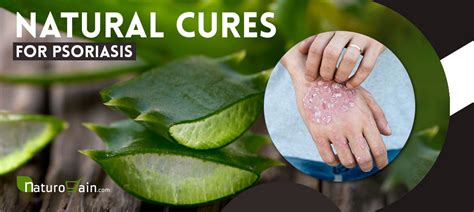 8 Natural Cures For Psoriasis Treat Symptoms Naturally At Home