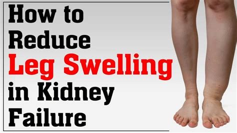 How To Reduce Leg Swelling Naturally In Kidney Failure Kidney