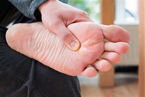 What Causes Plantar Warts And How Can I Get Rid Of Them Foot And