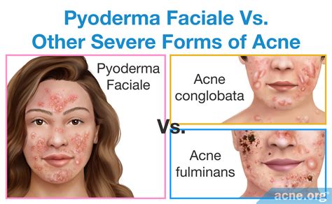 What Is Pyoderma Faciale