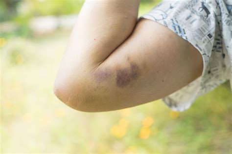 Why Do I Bruise So Easily 8 Odd Causes Of Bruising Easily