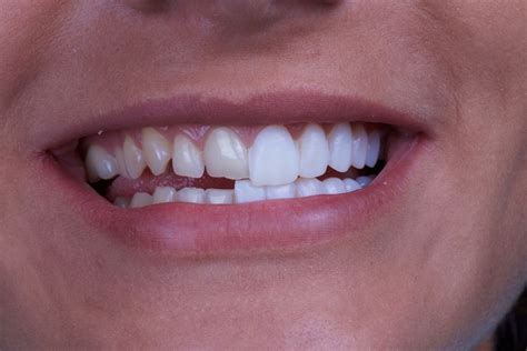 The Difference Between Veneers And Dental Bonding