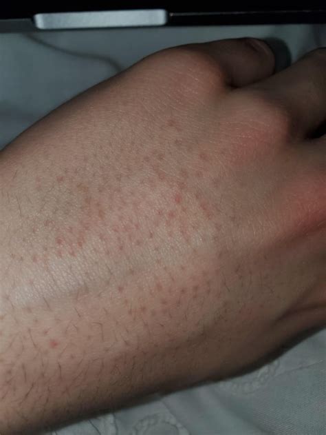 red dots on back of hands r accutane