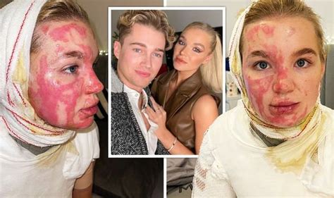 Dancer abbie quinnen, who was badly burned when a social media stunt went wrong, says she has received horrible messages from trolls on instagram since the accident in january. Vincent Simone and Matthew Wright voted off of I'm A Celebrity Get Me Out Of Here | Celebrity ...