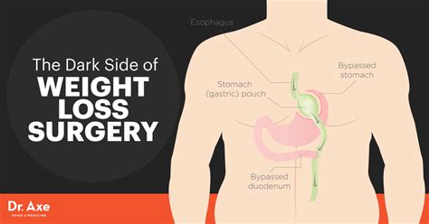 Bariatric Weight Loss Surgery Pros And Cons Blog Dandk