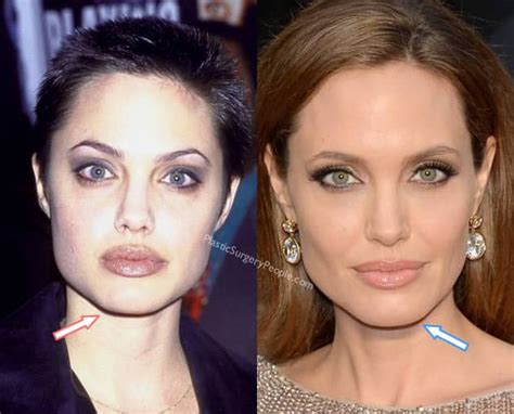 Angelina Jolie Nose Job And Cheek Implants Surgeries Plastic Surgery