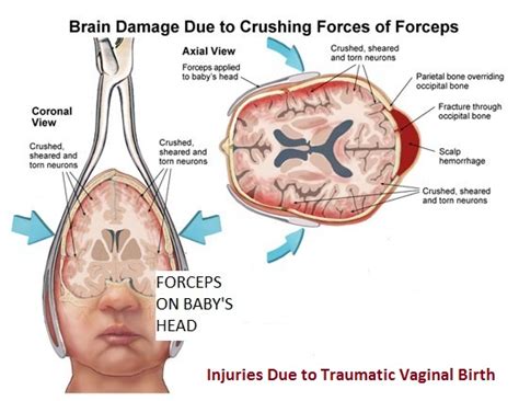 Source for information on birth trauma: Misuse of Forceps During Labor and Delivery | Passen Law ...