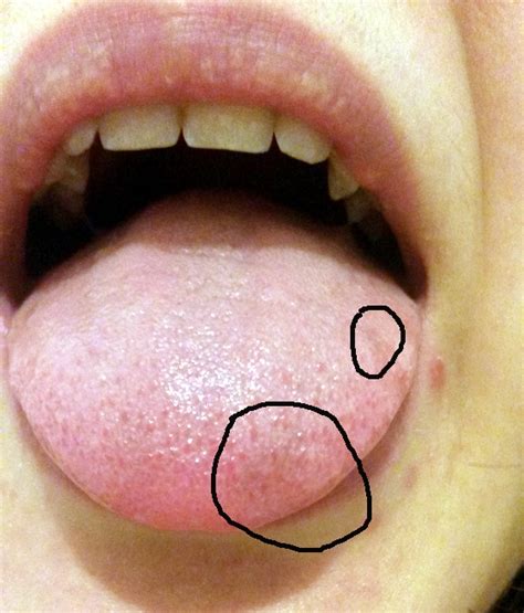 0 Result Images Of Why Are There Red Bumps On My Tongue Png Image