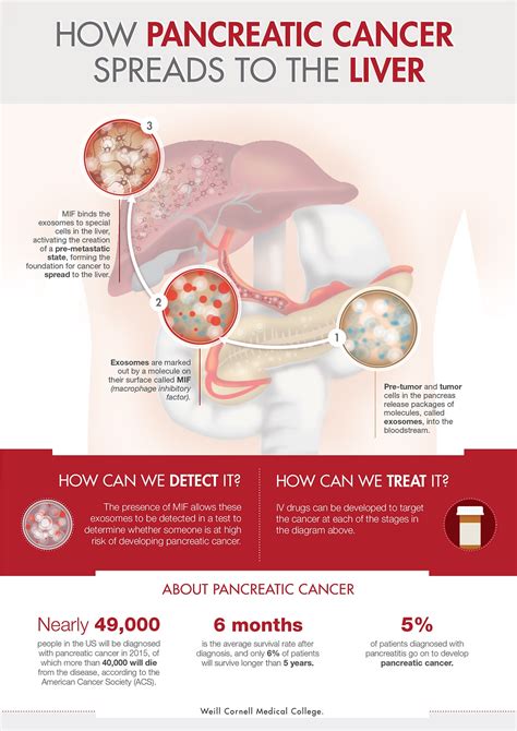 Azist - Infographics Portfolio - Pancreatic Cancer