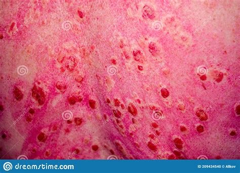Discoid Rash Of System Lupus Eruthematosus Stock Photo Image Of