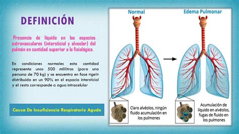 Edema Agudo Pulmonar Tratamiento Image To U