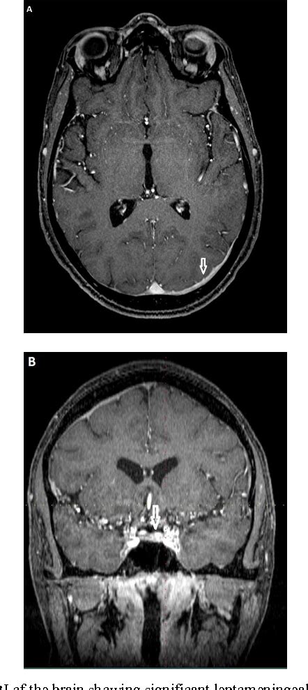 Figure 1 From Uveitis And Hypertrophic Pachymeningitis With Elevated