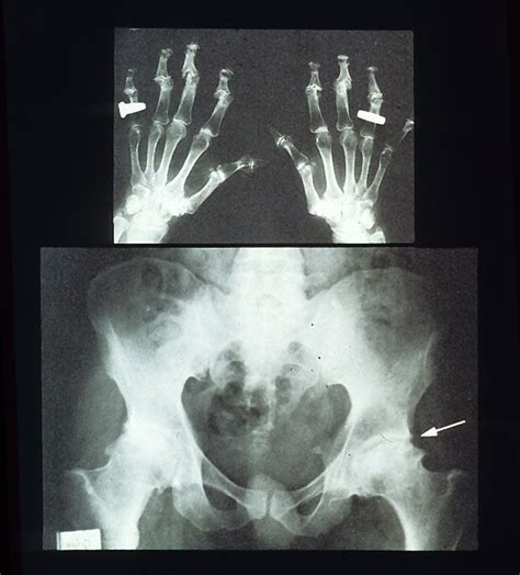 Usmlepathslides “ Osteoarthritis Note X Ray Of Hands And Oa In The Dip