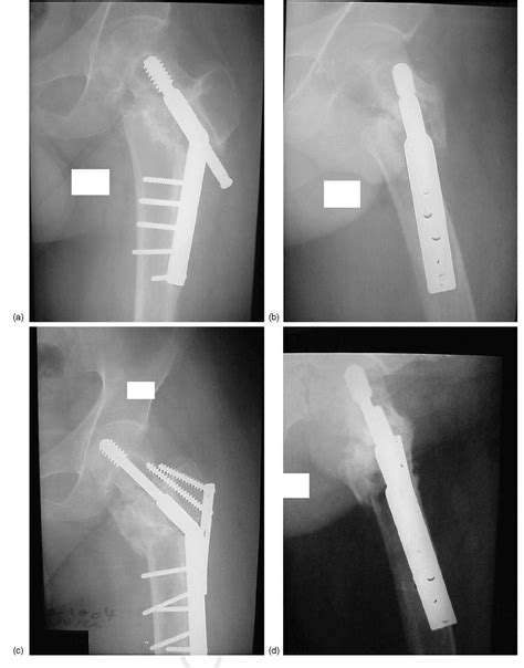 Figure 1 From Salvage Of Failed Dynamic Hip Screw Fixation Of