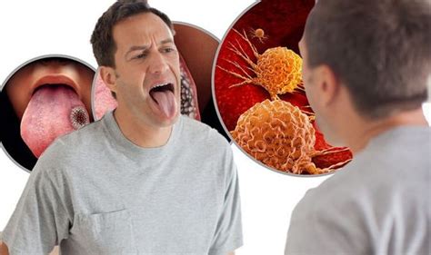 Cancer Symptoms Signs Include Red Or White Patch On Your Tongue