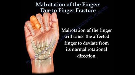 Finger Fractures Malrotation Of The Fingers Everything You Need To