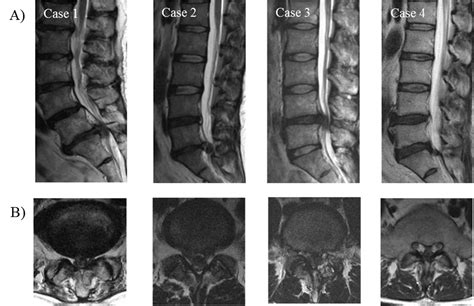 Cureus Massive Lumbar Disc Herniation Causing Cauda Equina Syndrome That Presents As Bladder