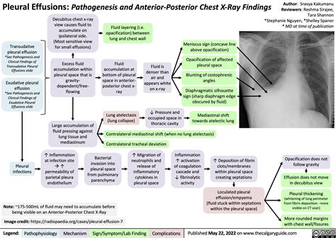 Pleural Effusions Pathogenesis And Anterior Posterior Chest X Ray
