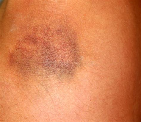 The Bruise On His Knee The Bruise On His Leg Stock Image Image Of