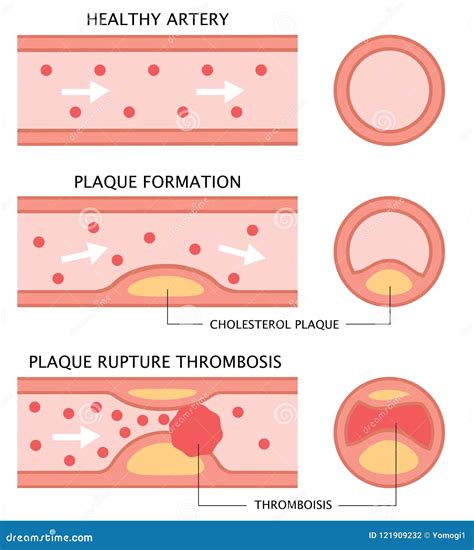 Diagram Diagram Of Blood Vessels Developing Atherosclerosis