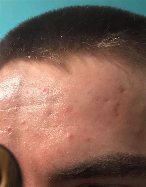 Deep Indentation In The Middle Of My Forehead Scar Treatments Acne