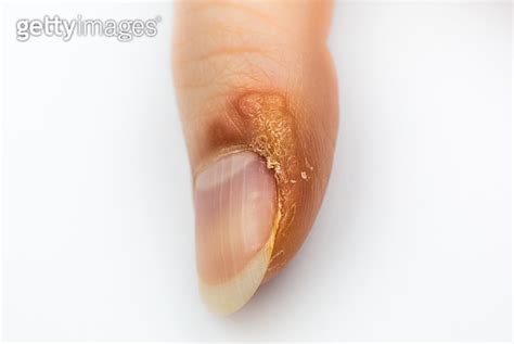 Close Up Wart On Finger Contagious Skin Illness On Womans Hand