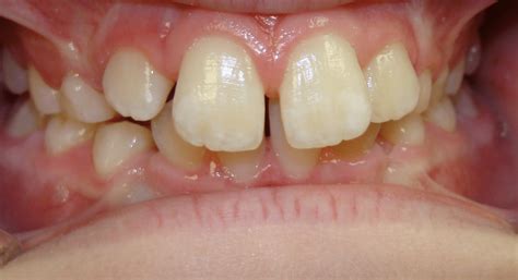 Before After Smiles Woodhill Dental Specialties Dallas Tx