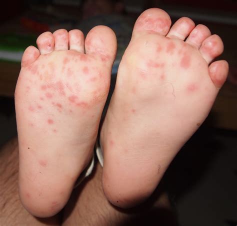Natural Remedy For Hand Foot And Mouth Disease Remedygrove