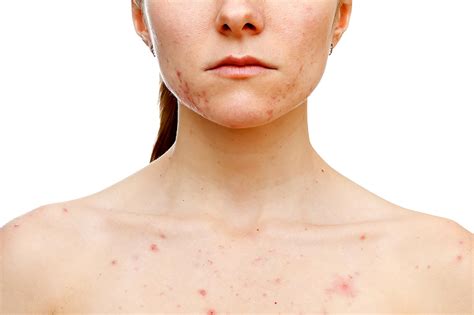 Chest Acne What Causes It And How To Get Rid Of It Readers Digest
