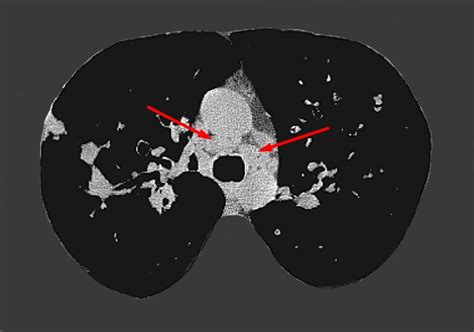 E Ct Scan Hrct Lungs Lymphadenopathy