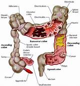 Images of Small Bowel Crohn''s Treatment