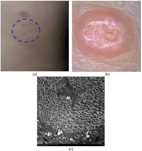 Observation Of Viruses Bacteria And Fungi In Clinical Skin Samples