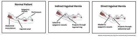 Direct And Indirect Inguinal Hernia
