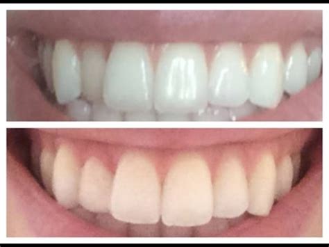 Learn how to cure bleeding and receding gums when you brush your teeth. Fixing a crooked tooth inexpensively - "Dental Composite ...