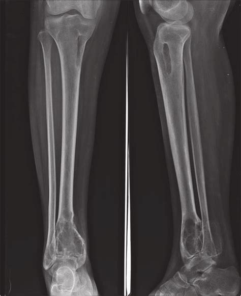 Right Leg Radiography Showing Bone Changes In The Distal Tibia