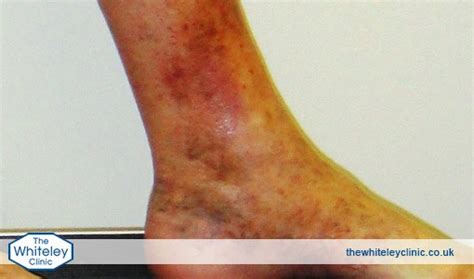 What Is Phlebitis The Whiteley Clinic