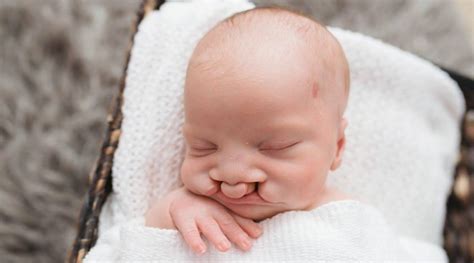 Tips For Caring For Your Baby With A Cleft Lip And Palate Unc Health Talk