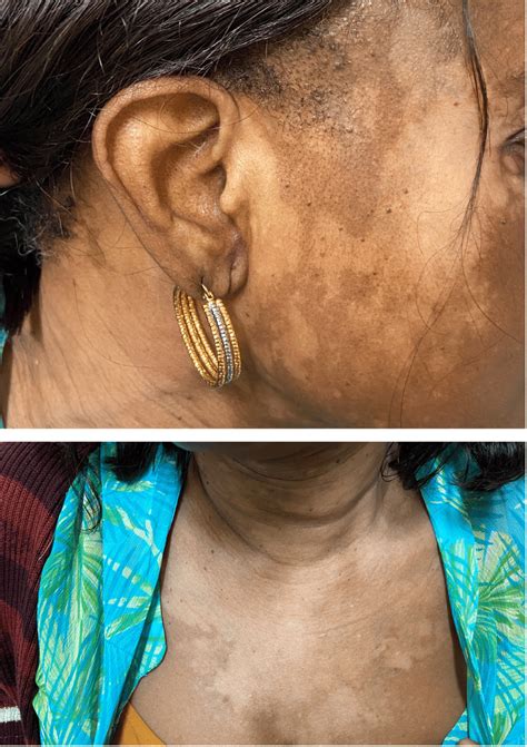 Depigmented Patches On The Patients Face Neck And Chest Download
