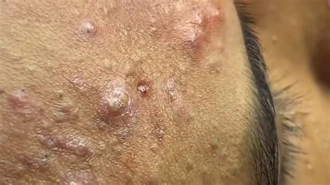 Big Whitehead Removal That Embedded Deeply In Allergic Skin Youtube