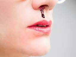 This mostly occurs in summer when the minute blood capillaries burst summers are usually dry and hence bad for your nose. Nosebleeds: Causes, treatment, and home remedies