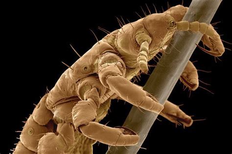 Huge Rise In Head Lice And Nits Expected As Nhs Scraps Treatment