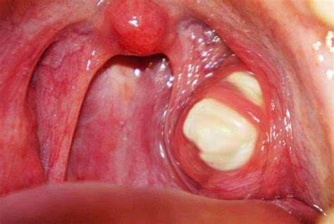 White Lump On Tonsil Causes Symptoms Diagnosis Treatment Removal