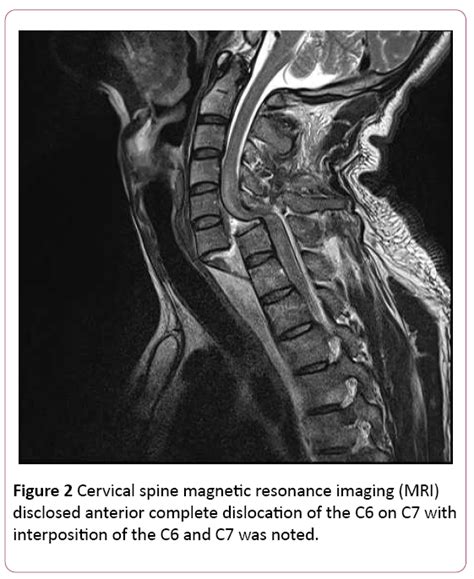 An Easily Missed Case Of Severely Injured Cervical Dislocation
