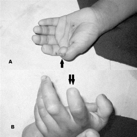 Radiographs Of Hands And Feet A Right Hand Showing Osteoacrolysis Of