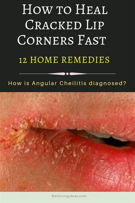 12 Home Treatments To Heal Cracked Lip Corners Fast Natural Lip Care